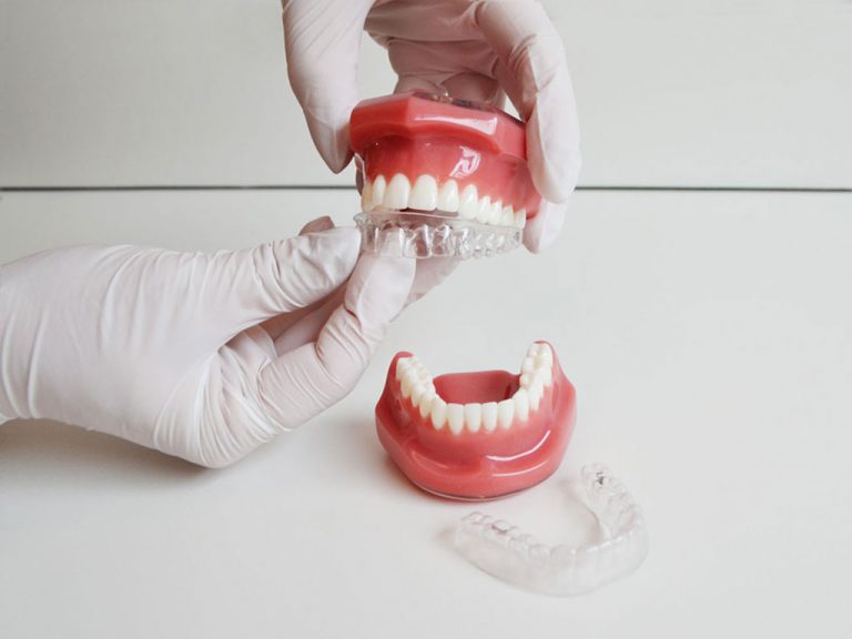 Behandlung durch Zahnschienen bei ZAHNDESIGN | Ihre moderen Zahnarztpraxis in München Pasing