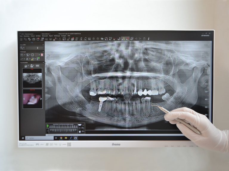 Parodontitistherapie bei ZAHNDESIGN | Ihre moderne Zahnarztpraxis in München Pasing